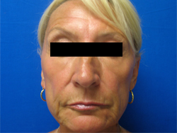 After Image: Patient # 11582 - 