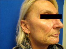 Before Image: Patient # 11582 - 