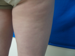 Before Image: Patient # 16455 - 