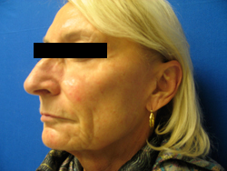Before Image: Patient # 11582 - 