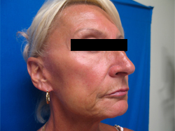 After Image: Patient # 11582 - 