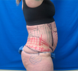 Before Image: Patient # 84741 - 
