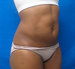 After Image: Patient # 33413 - 