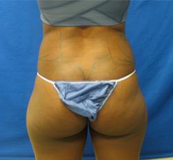 Before Image: Patient # 33413 - 