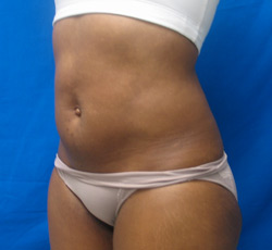 After Image: Patient # 33413 - 