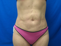 After Image: Patient # 90987 - 