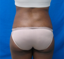 After Image: Patient # 33413 - 