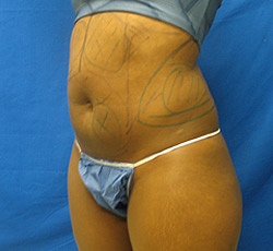 Before Image: Patient # 33413 - 