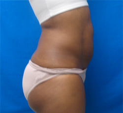 Before Image: Patient # 33413 - 