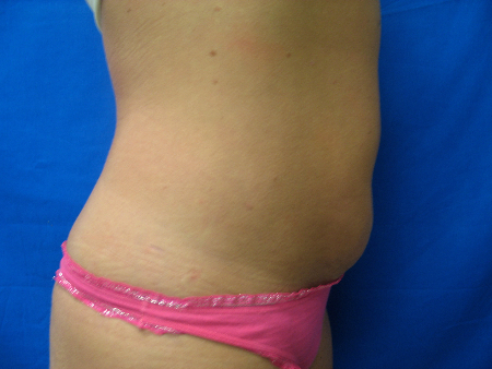 After Image: Patient # 90987 - 