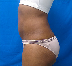 After Image: Patient # 33413 - 