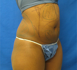 Before Image: Patient # 33413 - 