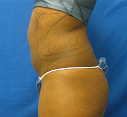 Before Image: Patient # 33413 - 