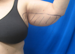 Before Image: Patient # 91612 - 