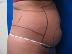 Before Image: Patient # 90987 - 