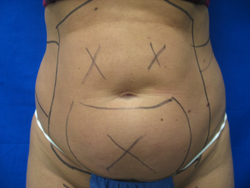 Before Image: Patient # 90987 - 