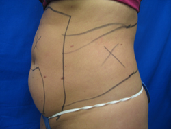 Before Image: Patient # 90987 - 