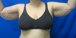 Before Image: Patient # 91612 - 