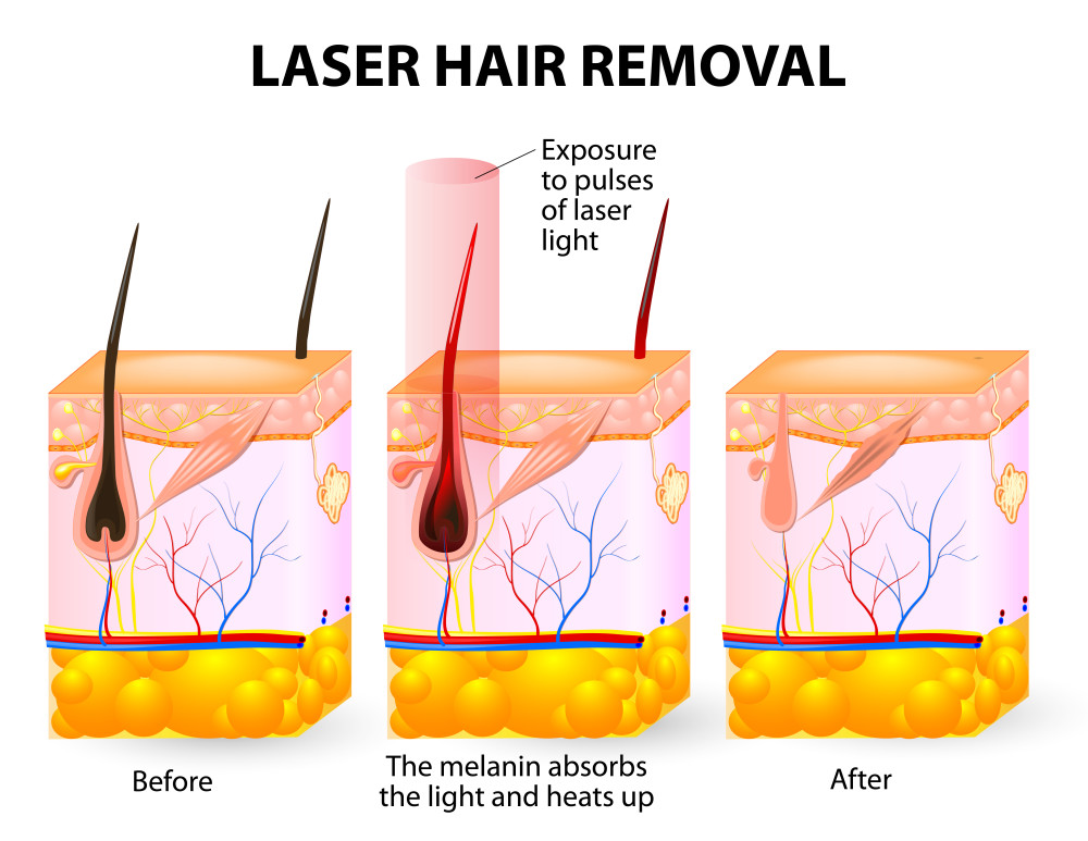Laser Hair Removal Buffalo, NY