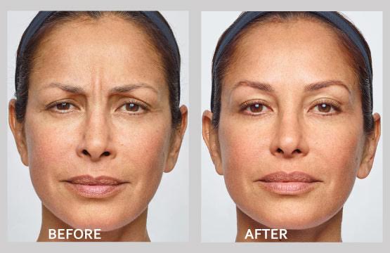 Dysport Xeomin In Buffalo And Williamsville Ny Dr Bertolino