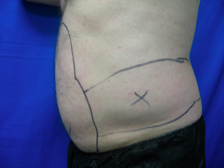 Before Image: Patient # 66363 - 