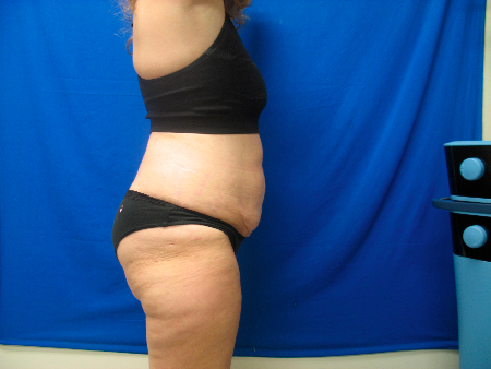After Image: Patient # 42573 - 