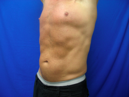 After Image: Patient # 66363 - 