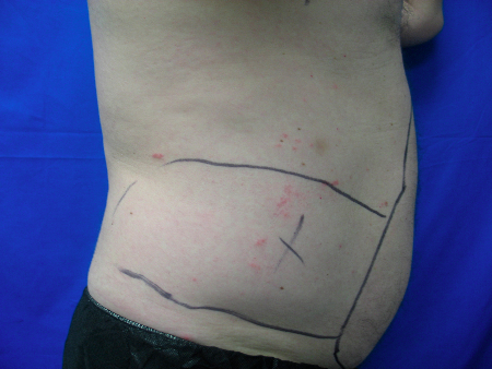 Before Image: Patient # 66363 - 
