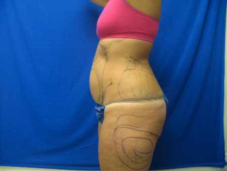 After Image: Patient # 16343 - 