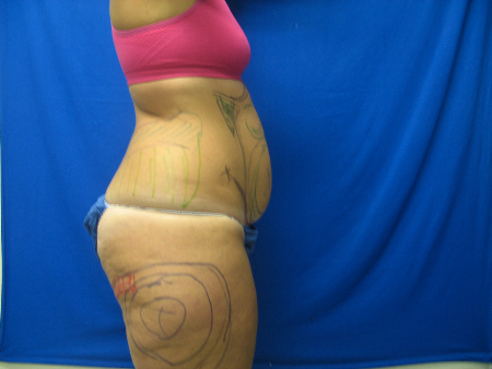 Before Image: Patient # 16343 - 