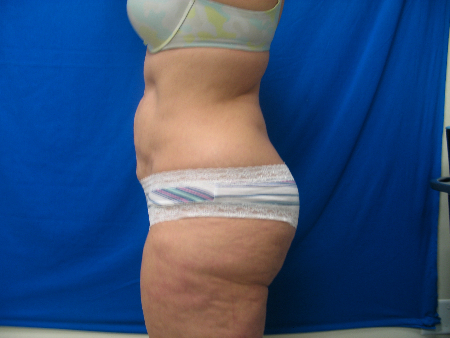 Before Image: Patient # 81330 - 