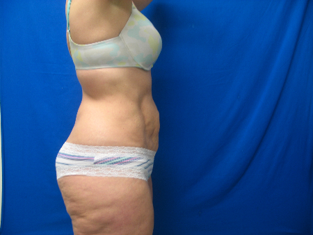 After Image: Patient # 81330 - 