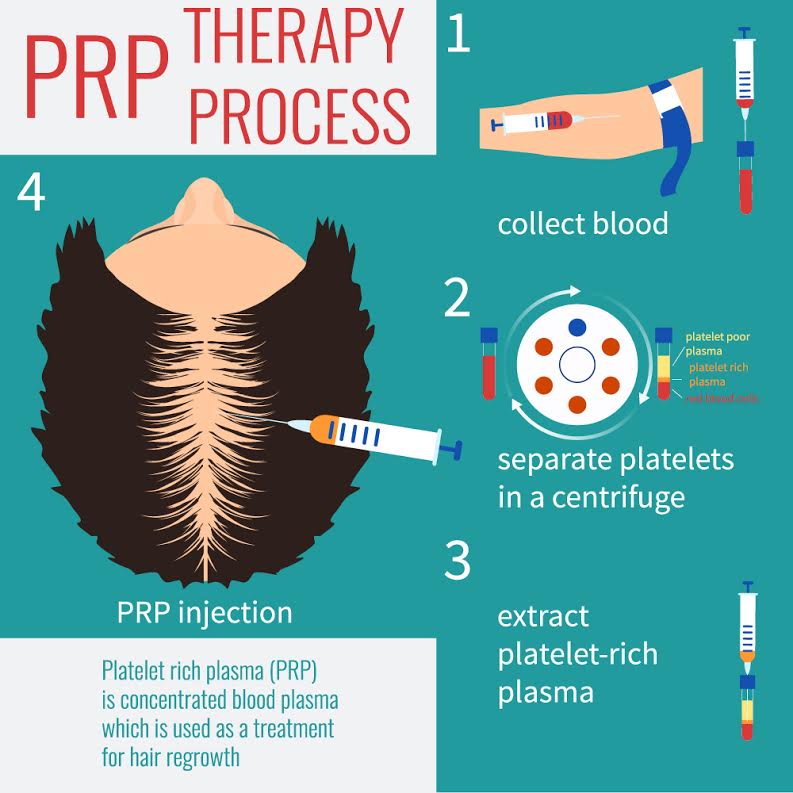 PRP Hair Restoration NY