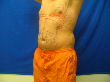 Before Image: Patient # 51865 - 
