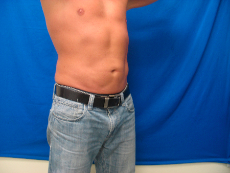 After Image: Patient # 51865 - 