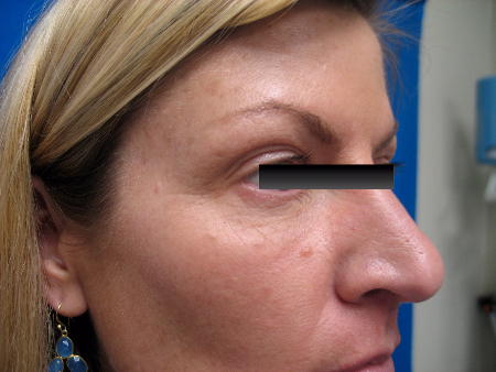 Before Image: Patient # 81699 - 