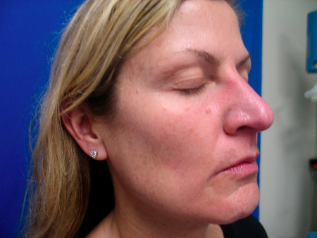After Image: Patient # 81699 - 