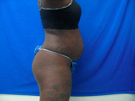 Before Image: Patient # 69942 - 