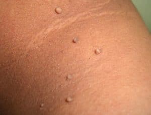 skin tags 300x229 1