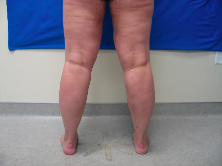 After Image: Patient # 14535 - 