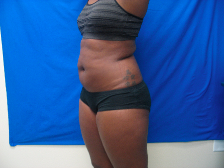 After Image: Patient # 60883 - 