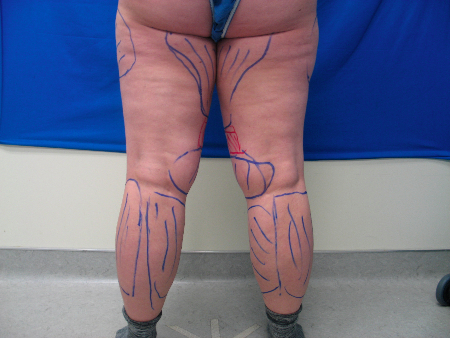 Before Image: Patient # 14535 - 