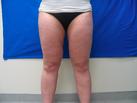 After Image: Patient # 14535 - 