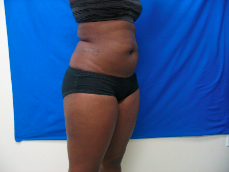 After Image: Patient # 60883 - 