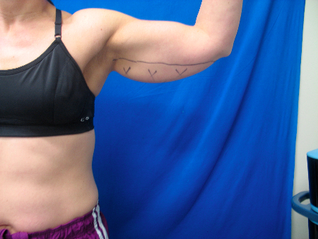 Before Image: Patient # 79587 - 