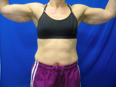 Before Image: Patient # 79587 - 