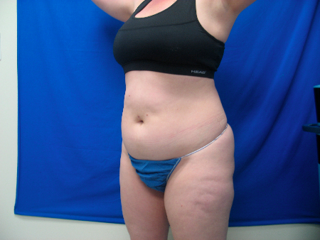 Before Image: Patient # 12078 - 