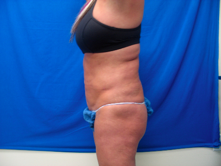 Before Image: Patient # 96983 - 