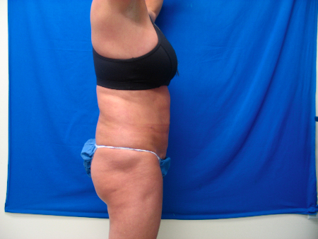 Before Image: Patient # 96983 - 