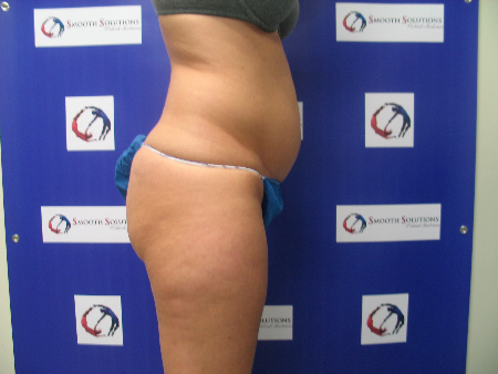 Before Image: Patient # 57037 - 